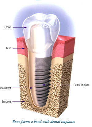 implant_diagram.jpg